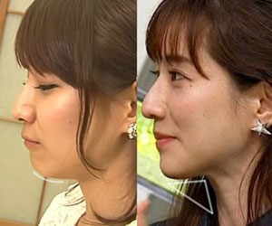 田中みな実, 顎, 横顔, 変わった, 整形疑惑