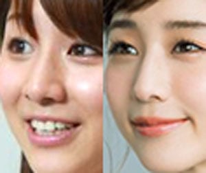 田中みな実, 鼻, 変わった, 比較